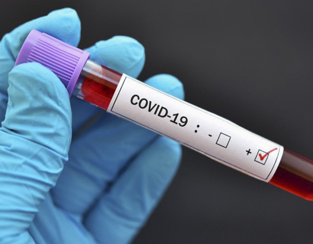 ÜST: Son 28 gündə dünyada COVID-19-a yoluxma 63% artıb
